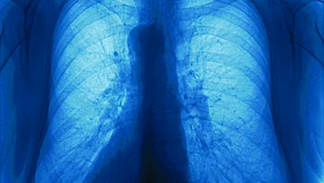 肺部x光片.
